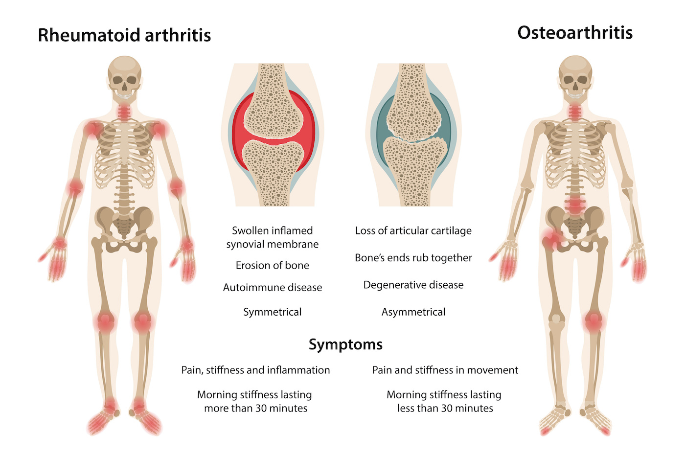 osteoarhtritis-subhash-goyal